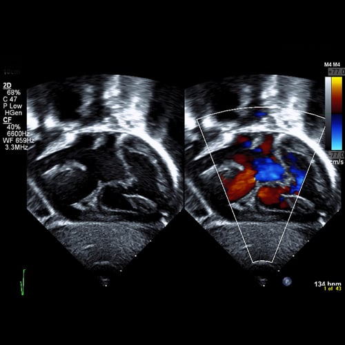 CHD Awareness Week